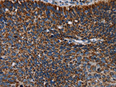 The image on the left is immunohistochemistry of paraffin-embedded Human cervical cancer tissue using the antibody Antibody) at dilution 1/60, on the right is treated with fusion protein. (Original magnification: ×200)Rabbit anti-Human IDH2 Polyclonal Antibody