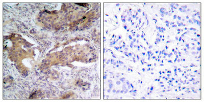 Immunohistochemical analysis of paraffin- embedded human breast carcinoma tissue using PTEN (phospho-Ser370) antibody.Rabbit anti-Human PTEN Polyclonal Antibody