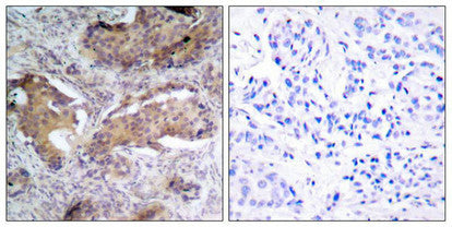 Immunohistochemical analysis of paraffin- embedded human breast carcinoma tissue using PTEN (phospho-Ser370) antibody.Rabbit anti-Human PTEN Polyclonal Antibody