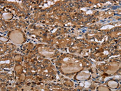 The image on the left is immunohistochemistry of paraffin-embedded Human thyroid cancer tissue using the antibody Antibody) at dilution 1/50, on the right is treated with synthetic peptide. (Original magnification: ×200)Rabbit anti-Human MT-ND1 Polyclonal Antibody