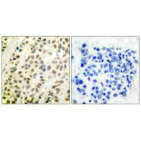 Immunohistochemical analysis of paraffin-embedded human breast carcinoma tissue using DP-1 antibody.Rabbit anti-Human TFDP1 Polyclonal Antibody