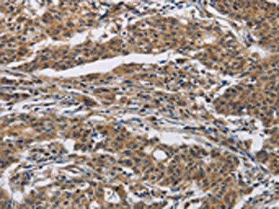 The image on the left is immunohistochemistry of paraffin-embedded Human gastric cancer tissue using IFNGR2 Antibody(IFNGR2 Antibody) at dilution 1/40, on the right is treated with synthetic peptide. (Original magnification: ×200)Rabbit anti-Human IFNGR2 Polyclonal Antibody