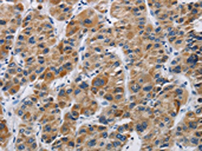 The image on the left is immunohistochemistry of paraffin-embedded Human liver cancer tissue using the antibody Antibody) at dilution 1/40, on the right is treated with synthetic peptide. (Original magnification: ×200)Rabbit anti-Human IFNGR2 Polyclonal Antibody