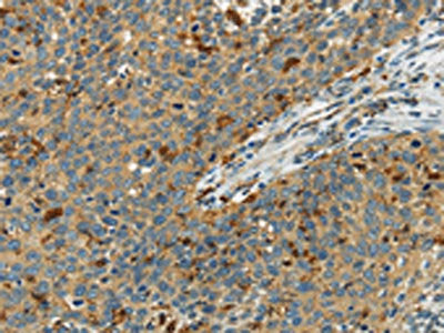 The image on the left is immunohistochemistry of paraffin-embedded Human cervical cancer tissue using AIF1 Antibody(AIF1 Antibody) at dilution 1/40, on the right is treated with fusion protein. (Original magnification: ×200)Rabbit anti-Human AIF1 Polyclonal Antibody