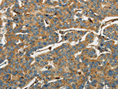 The image on the left is immunohistochemistry of paraffin-embedded Human breast cancer tissue using the antibody Antibody) at dilution 1/40, on the right is treated with fusion protein. (Original magnification: ×200)Rabbit anti-Human AIF1 Polyclonal Antibody