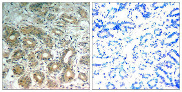 Immunohistochemical analysis of paraffin-embedded human breast carcinoma tissue using SHP-2(Ab-542) Antibody(left) or the same antibody preincubated with blocking peptide(right).Rabbit anti-Human PTPN11 Polyclonal Antibody