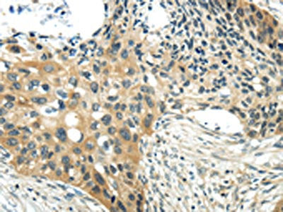 The image on the left is immunohistochemistry of paraffin-embedded Human esophagus cancer tissue using CHGA Antibody(CHGA  Antibody) at dilution 1/35, on the right is treated with synthetic peptide. (Original magnification: ×200)Rabbit anti-Human CHGA Polyclonal Antibody