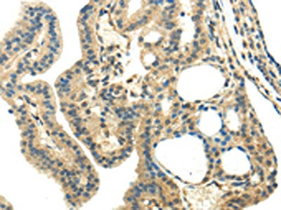 The image on the left is immunohistochemistry of paraffin-embedded Human thyroid cancer tissue using the antibody  Antibody) at dilution 1/35, on the right is treated with synthetic peptide. (Original magnification: ×200)Rabbit anti-Human CHGA Polyclonal Antibody