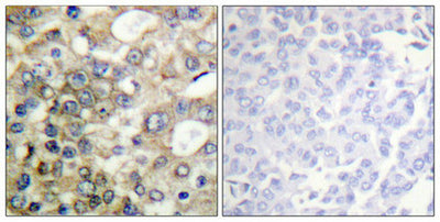 Immunohistochemical analysis of paraffin-embedded human breast carcinoma tissue using CD227/MUC1 (Phospho-Tyr1229) antibody (left)or the same antibody preincubated with blocking peptide (right).Rabbit anti-Human MUC1 Polyclonal Antibody