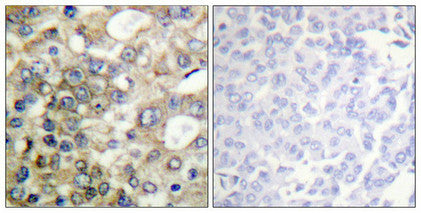 Immunohistochemical analysis of paraffin-embedded human breast carcinoma tissue using CD227/MUC1 (Phospho-Tyr1229) antibody (left)or the same antibody preincubated with blocking peptide (right).Rabbit anti-Human MUC1 Polyclonal Antibody