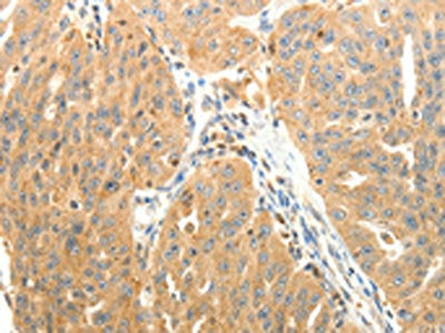 The image on the left is immunohistochemistry of paraffin-embedded Human ovarian cancer tissue using PTPN6 Antibody(PTPN6 Antibody) at dilution 1/40, on the right is treated with fusion protein. (Original magnification: ×200)Rabbit anti-Human PTPN6 Polyclonal Antibody