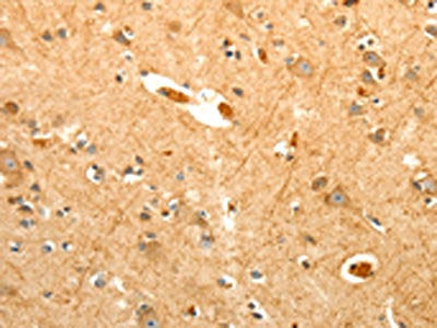 The image on the left is immunohistochemistry of paraffin-embedded Human brain tissue using the antibody Antibody) at dilution 1/40, on the right is treated with fusion protein. (Original magnification: ×200)Rabbit anti-Human PTPN6 Polyclonal Antibody