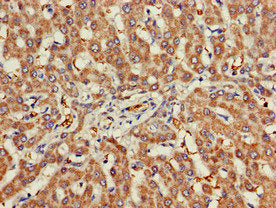 Immunohistochemistry of paraffin-embedded human liver cancer using CHRNB1 Antibody at dilution of 1:100Rabbit anti-Human CHRNB1 Polyclonal Antibody