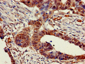 Immunohistochemistry of paraffin-embedded human colon cancer using CHRNB1 Antibody at dilution of 1:100Rabbit anti-Human CHRNB1 Polyclonal Antibody