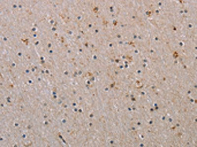 The image on the left is immunohistochemistry of paraffin-embedded Human brain  tissue using RAB39B Antibody(RAB39B Antibody) at dilution 1/45, on the right is treated with synthetic peptide. (Original magnification: ×200)Rabbit anti-Human RAB39B Polyclonal Antibody