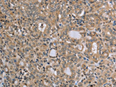 The image on the left is immunohistochemistry of paraffin-embedded Human thyroid cancer tissue using the antibody Antibody) at dilution 1/45, on the right is treated with synthetic peptide. (Original magnification: ×200)Rabbit anti-Human RAB39B Polyclonal Antibody