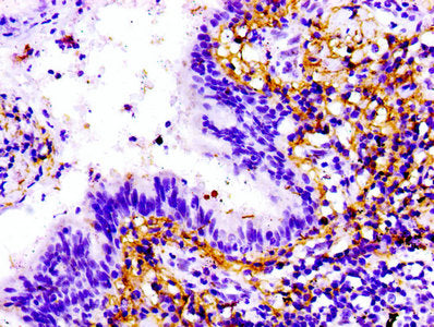 IHC image of TTN Antibody diluted at 1:100 and staining in paraffin-embedded human lung cancer performed on a Leica BondTM system. After dewaxing and hydration, antigen retrieval was mediated by high pressure in a citrate buffer (pH 6.0). Section was blocked with 10% normal goat serum 30min at RT. Then primary antibody (1% BSA) was incubated at 4°C overnight. The primary is detected by a biotinylated secondary antibody and visualized using an HRP conjugated SP system.Rabbit anti-Human TTN Polyclonal Antibody