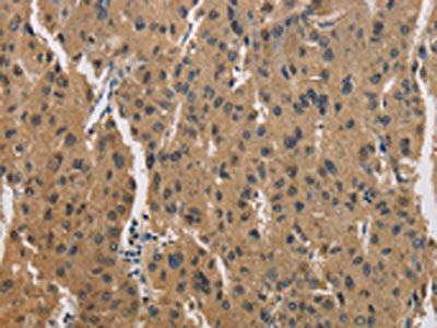 The image is immunohistochemistry of paraffin-embedded Human liver cancer tissue using CKMT2 Antibody(CKMT2 Antibody) at dilution 1/60. (Original magnification: ×200)Rabbit anti-Human CKMT2 Polyclonal Antibody
