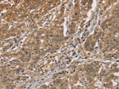 The image is immunohistochemistry of paraffin-embedded Human gastic cancer tissue using the antibody Antibody) at dilution 1/60. (Original magnification: ×200)Rabbit anti-Human CKMT2 Polyclonal Antibody