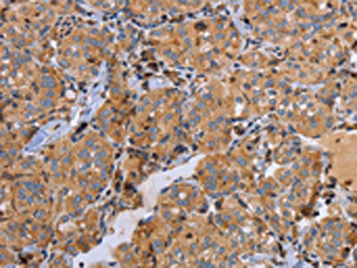 The image on the left is immunohistochemistry of paraffin-embedded Human thyroid cancer tissue using MMP9 Antibody(MMP9 Antibody) at dilution 1/20, on the right is treated with synthetic peptide. (Original magnification: ×200)Rabbit anti-Human MMP9 Polyclonal Antibody