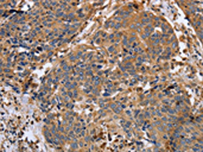 The image on the left is immunohistochemistry of paraffin-embedded Human cervical cancer tissue using the antibody Antibody) at dilution 1/20, on the right is treated with synthetic peptide. (Original magnification: ×200)