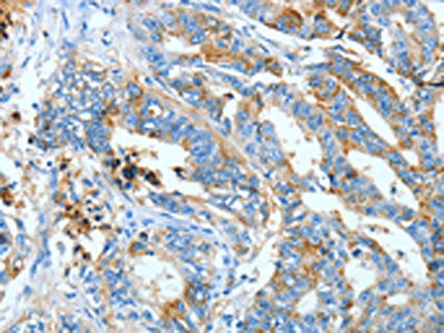 The image on the left is immunohistochemistry of paraffin-embedded Human gastric cancer tissue using ANXA13 Antibody(ANXA13 Antibody) at dilution 1/40, on the right is treated with fusion protein. (Original magnification: ×200)Rabbit anti-Human ANXA13 Polyclonal Antibody