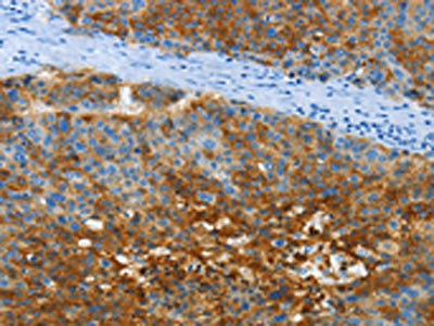 The image on the left is immunohistochemistry of paraffin-embedded Human liver cancer tissue using the antibody Antibody) at dilution 1/40, on the right is treated with fusion protein. (Original magnification: ×200)Rabbit anti-Human ANXA13 Polyclonal Antibody