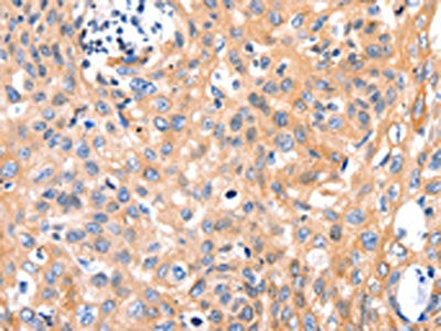 The image on the left is immunohistochemistry of paraffin-embedded Human cervical cancer tissue using MYL9 Antibody(MYL9 Antibody) at dilution 1/80, on the right is treated with synthetic peptide. (Original magnification: ×200)Rabbit anti-Human MYL9 Polyclonal Antibody