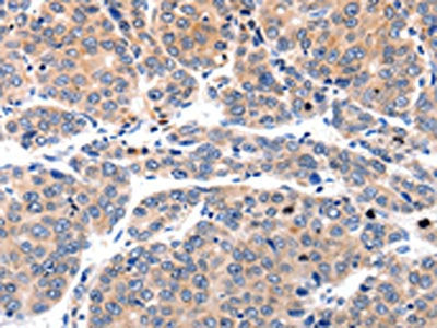 The image on the left is immunohistochemistry of paraffin-embedded Human liver cancer tissue using the antibody Antibody) at dilution 1/80, on the right is treated with synthetic peptide. (Original magnification: ×200)Rabbit anti-Human MYL9 Polyclonal Antibody