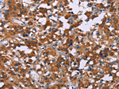 The image on the left is immunohistochemistry of paraffin-embedded Human thyroid cancer tissue using the antibody Antibody) at dilution 1/30, on the right is treated with synthetic peptide. (Original magnification: ×200)