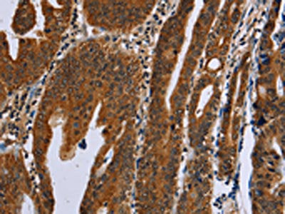 The image on the left is immunohistochemistry of paraffin-embedded Human gastric cancer tissue using GH2 Antibody(GH2 Antibody) at dilution 1/60, on the right is treated with fusion protein. (Original magnification: ×200)Rabbit anti-Human GH2 Polyclonal Antibody