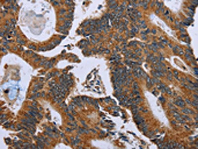 The image on the left is immunohistochemistry of paraffin-embedded Human colon cancer tissue using the antibody Antibody) at dilution 1/60, on the right is treated with fusion protein. (Original magnification: ×200)Rabbit anti-Human GH2 Polyclonal Antibody