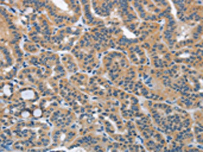 The image on the left is immunohistochemistry of paraffin-embedded Human thyroid cancer tissue using the antibody Antibody) at dilution 1/40, on the right is treated with fusion protein. (Original magnification: ×200)Rabbit anti-Human HSD3B1 Polyclonal Antibody
