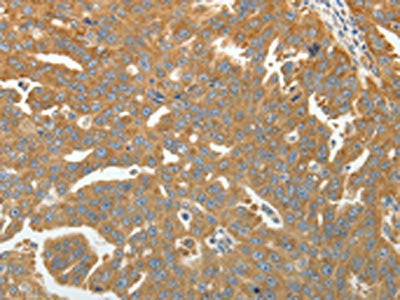 The image on the left is immunohistochemistry of paraffin-embedded Human ovarian cancer tissue using RPLP0 Antibody(RPLP0 Antibody) at dilution 1/40, on the right is treated with fusion protein. (Original magnification: ×200)Rabbit anti-Human RPLP0 Polyclonal Antibody