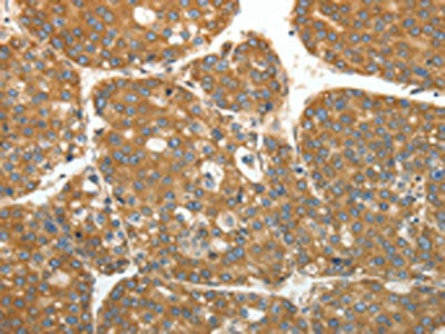 The image on the left is immunohistochemistry of paraffin-embedded Human liver cancer tissue using the antibody Antibody) at dilution 1/40, on the right is treated with fusion protein. (Original magnification: ×200)Rabbit anti-Human RPLP0 Polyclonal Antibody
