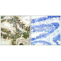 Immunohistochemical analysis of paraffin-embedded human colon carcinoma tissue using Cyclin E1 (Ab-395) antibody.Rabbit anti-Human CCNE1 Polyclonal Antibody