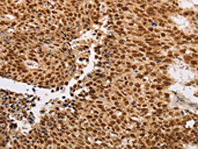 The image on the left is immunohistochemistry of paraffin-embedded Human lung cancer tissue using THOC7 Antibody(THOC7 Antibody) at dilution 1/30, on the right is treated with fusion protein. (Original magnification: ×200)Rabbit anti-Human THOC7 Polyclonal Antibody