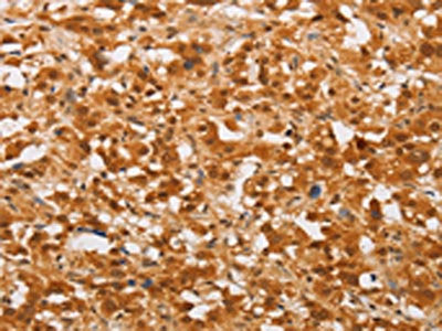 The image on the left is immunohistochemistry of paraffin-embedded Human thyroid cancer tissue using the antibody Antibody) at dilution 1/30, on the right is treated with fusion protein. (Original magnification: ×200)Rabbit anti-Human THOC7 Polyclonal Antibody