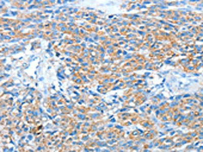 The image on the left is immunohistochemistry of paraffin-embedded Human esophagus cancer tissue using AFAP1 Antibody(AFAP1 Antibody) at dilution 1/20, on the right is treated with fusion protein. (Original magnification: X200)Rabbit anti-Human AFAP1 Polyclonal Antibody