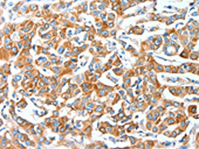 The image on the left is immunohistochemistry of paraffin-embedded Human breast cancer tissue using the antibody Antibody) at dilution 1/20, on the right is treated with fusion protein. (Original magnification: X200)