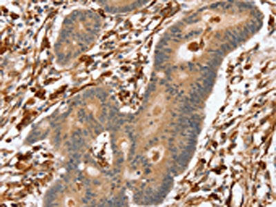 The image on the left is immunohistochemistry of paraffin-embedded Human colon cancer tissue using SSX2IP Antibody(SSX2IP Antibody) at dilution 1/45, on the right is treated with fusion protein. (Original magnification: ×200)Rabbit anti-Human SSX2IP Polyclonal Antibody