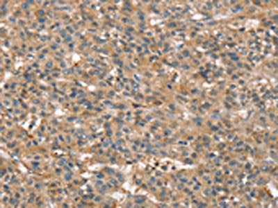 The image on the left is immunohistochemistry of paraffin-embedded Human liver cancer tissue using the antibody Antibody) at dilution 1/45, on the right is treated with fusion protein. (Original magnification: ×200)Rabbit anti-Human SSX2IP Polyclonal Antibody