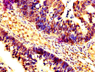 IHC image of CASP7 Antibody diluted at 1:200 and staining in paraffin-embedded human ovarian cancer performed on a Leica BondTM system. After dewaxing and hydration, antigen retrieval was mediated by high pressure in a citrate buffer (pH 6.0). Section was blocked with 10% normal goat serum 30min at RT. Then primary antibody (1% BSA) was incubated at 4°C overnight. The primary is detected by a biotinylated secondary antibody and visualized using an HRP conjugated SP system.