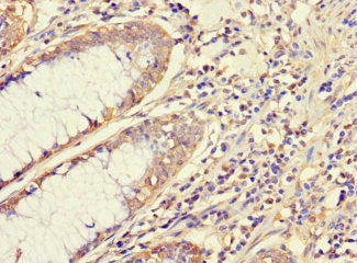 Immunohistochemistry of paraffin-embedded human colon cancer using the antibody at dilution of 1:100