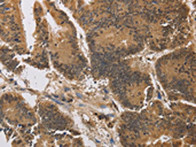 The image on the left is immunohistochemistry of paraffin-embedded Human colon cancer tissue using the antibody Antibody) at dilution 1/40, on the right is treated with synthetic peptide. (Original magnification: ×200)