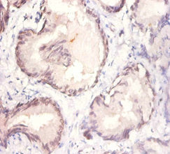 Immunohistochemistry of paraffin-embedded human prostate tissue using WNT3A Antibody at dilution of 1:50Rabbit anti-Human WNT3A Polyclonal Antibody