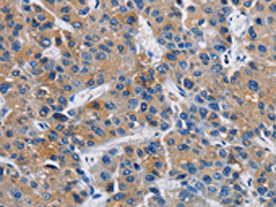 The image on the left is immunohistochemistry of paraffin-embedded Human liver cancer tissue using GPM6A Antibody(GPM6A Antibody) at dilution 1/40, on the right is treated with fusion protein. (Original magnification: ×200)Rabbit anti-Human GPM6A Polyclonal Antibody