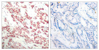 Immunohistochemical analysis of paraffin- embedded human breast carcinoma tissue using NF-κB p100 (phospho- ser866) antibody.Rabbit anti-Human NFKB2 Polyclonal Antibody