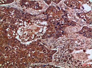 Immunohistochemical analysis of paraffin-embedded Human-lung-cancer, antibody was diluted at 1:100Rabbit anti-Human FLT4 Polyclonal Antibody
