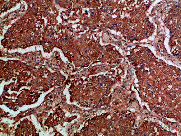 Immunohistochemical analysis of paraffin-embedded Human-lung-cancer, antibody was diluted at 1:100Rabbit anti-Human FLT4 Polyclonal Antibody